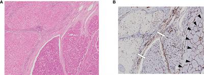 Association between vessels that encapsulate tumour clusters vascular pattern and hepatocellular carcinoma recurrence following liver transplantation